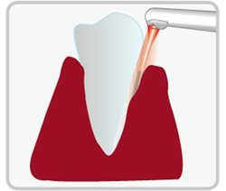 歯槽膿漏（歯周病）