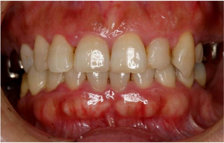 重度歯周病の写真